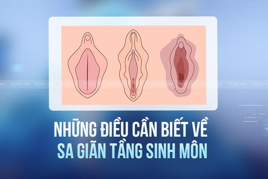 Sa tầng sinh môn và phương pháp điều trị