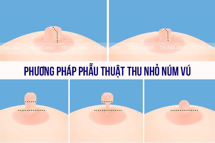 Phương pháp phẫu thuật thu nhỏ núm vú