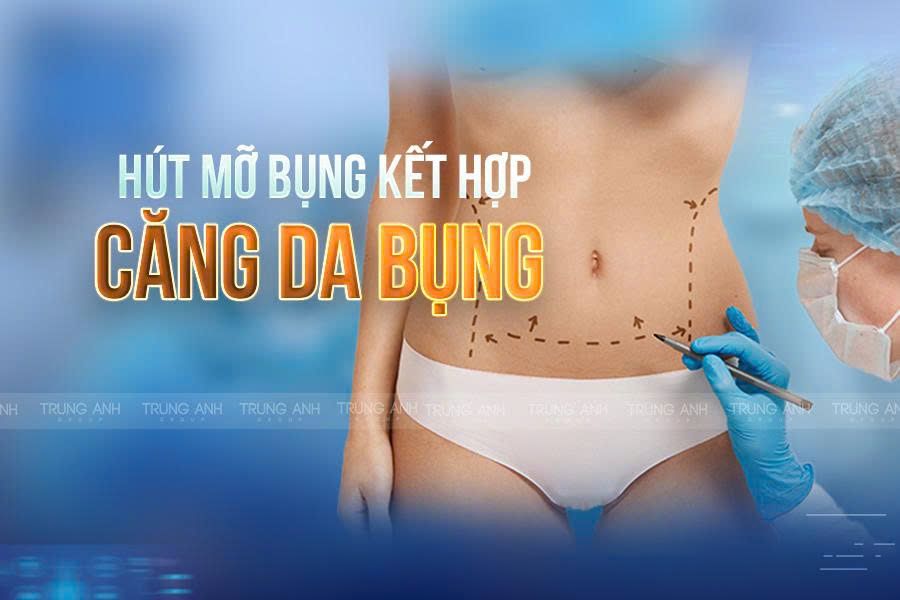 Hút mỡ kết hợp phương pháp căng da bụng