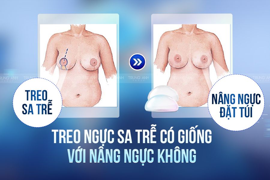 Treo ngực sa trễ có giống với nâng ngực không – bác sĩ của Trung Anh Group giải đáp