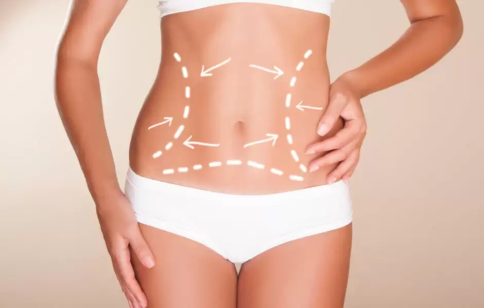 Hút mỡ, tạo hình bụng – Giải pháp lấy lại vóc dáng hiệu quả