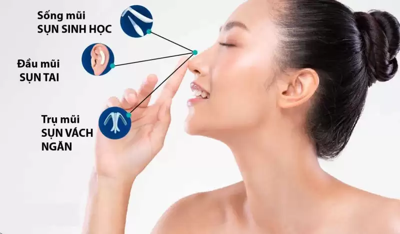 Tìm hiểu về các loại sụn nâng mũi cùng bác sĩ của Trung Anh Group
