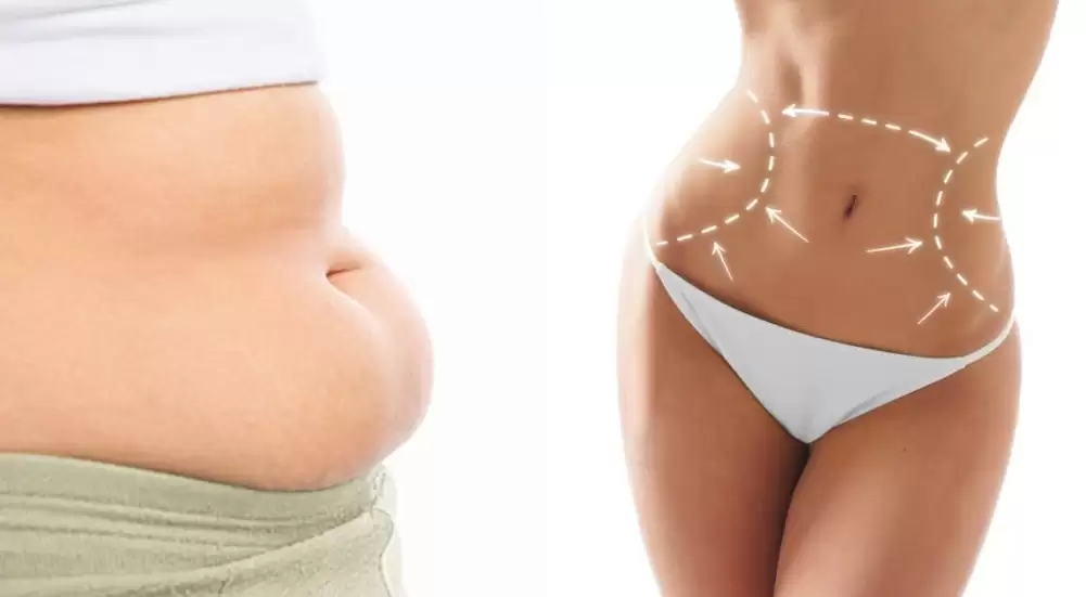 Hút mỡ là phương pháp giúp phái đẹp sở hữu vóc dáng mơ ước