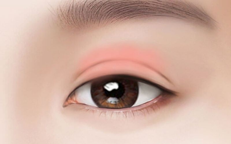 Vết cắt mí mắt bị đỏ sau thẩm mỹ khắc phục như thế na