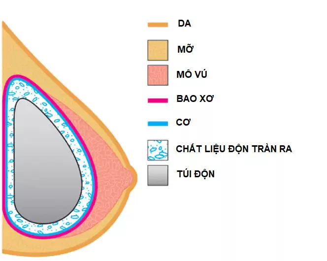 Hạn chế bao xơ sau nâng ngực bằng công nghệ dao siêu âm Harmonic