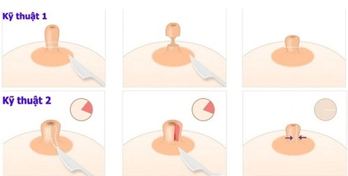 Thẩm mỹ thu nhỏ đầu nhũ hoa tại các bác sĩ của Trung Anh