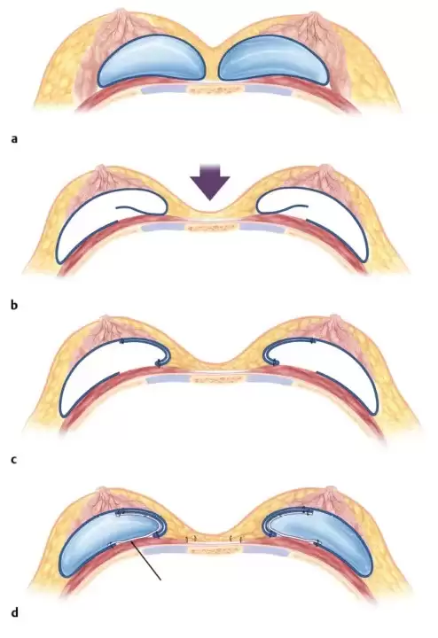 Nguyên nhân gây ra tình trạng thông khe ngực sau nâng