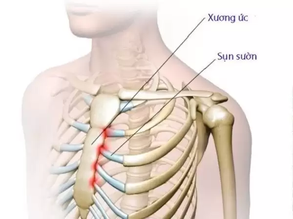 Giải đáp thắc mắc: Sụn sườn sử dụng trong phương pháp nâng mũi cấu trúc sụn sườn có bị teo lại không?