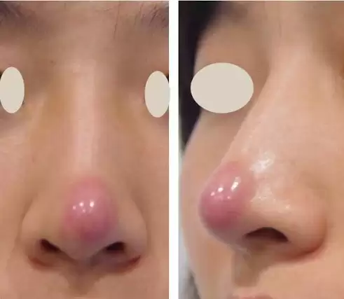 Biến chứng tụt sụn mũi sau nâng: Dấu hiệu và Nguyên nhân