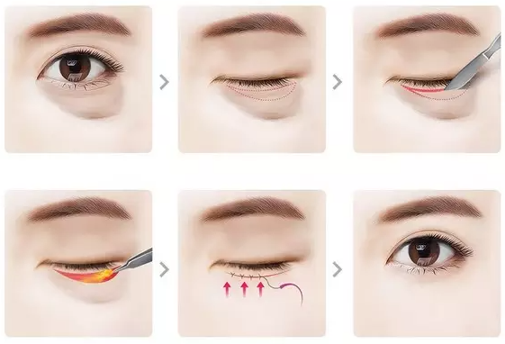 Thẩm mỹ mí mắt trả lại đôi mắt đẹp, trẻ trung cho bạn