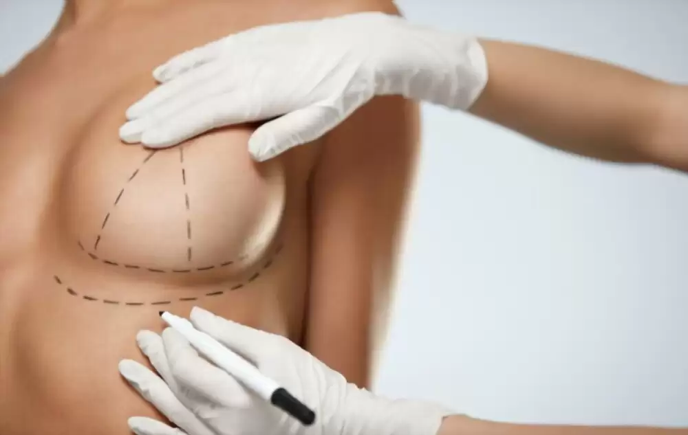 Các yếu tố hình thành sẹo xấu sau nâng ngực và cách phòng tránh