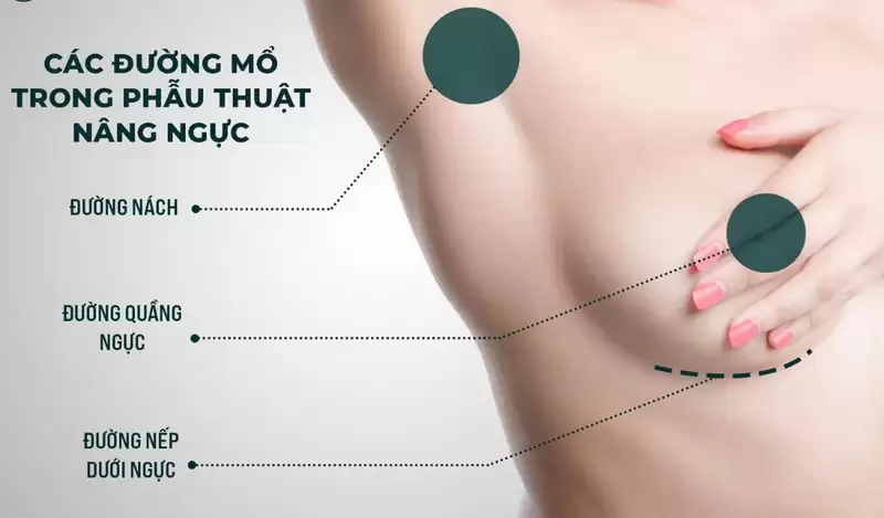 Nâng ngực đường quầng có bảo tồn được tuyến sữa?