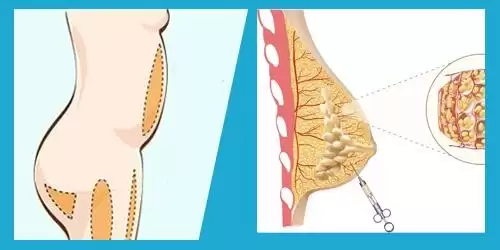 Nâng ngực đặt túi hay cấy mỡ tự thân tốt hơn