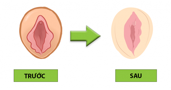 Thẩm mỹ vùng kín bao lâu thì lành, đẹp tự nhiên