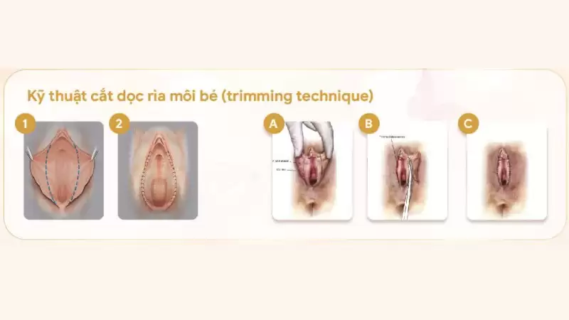 Nên lựa chọn kỹ thuật nào khi thẩm mỹ “cô bé”