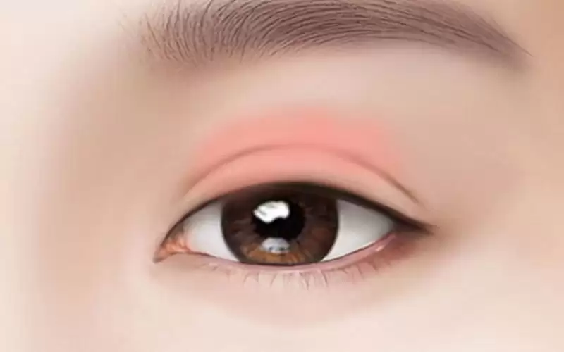 Lấy mỡ thừa mí mắt có tác dụng gì và khi nào cần lấy mỡ thừa mí mắt