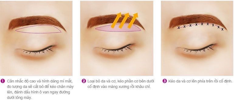 Phương pháp treo cung mày giúp trẻ hóa gương mặt