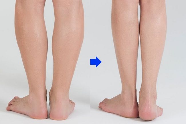 Những điều cần biết về hút mỡ bắp chân