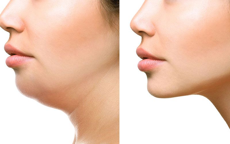 Hút mỡ nọng cằm có nguy hiểm không?