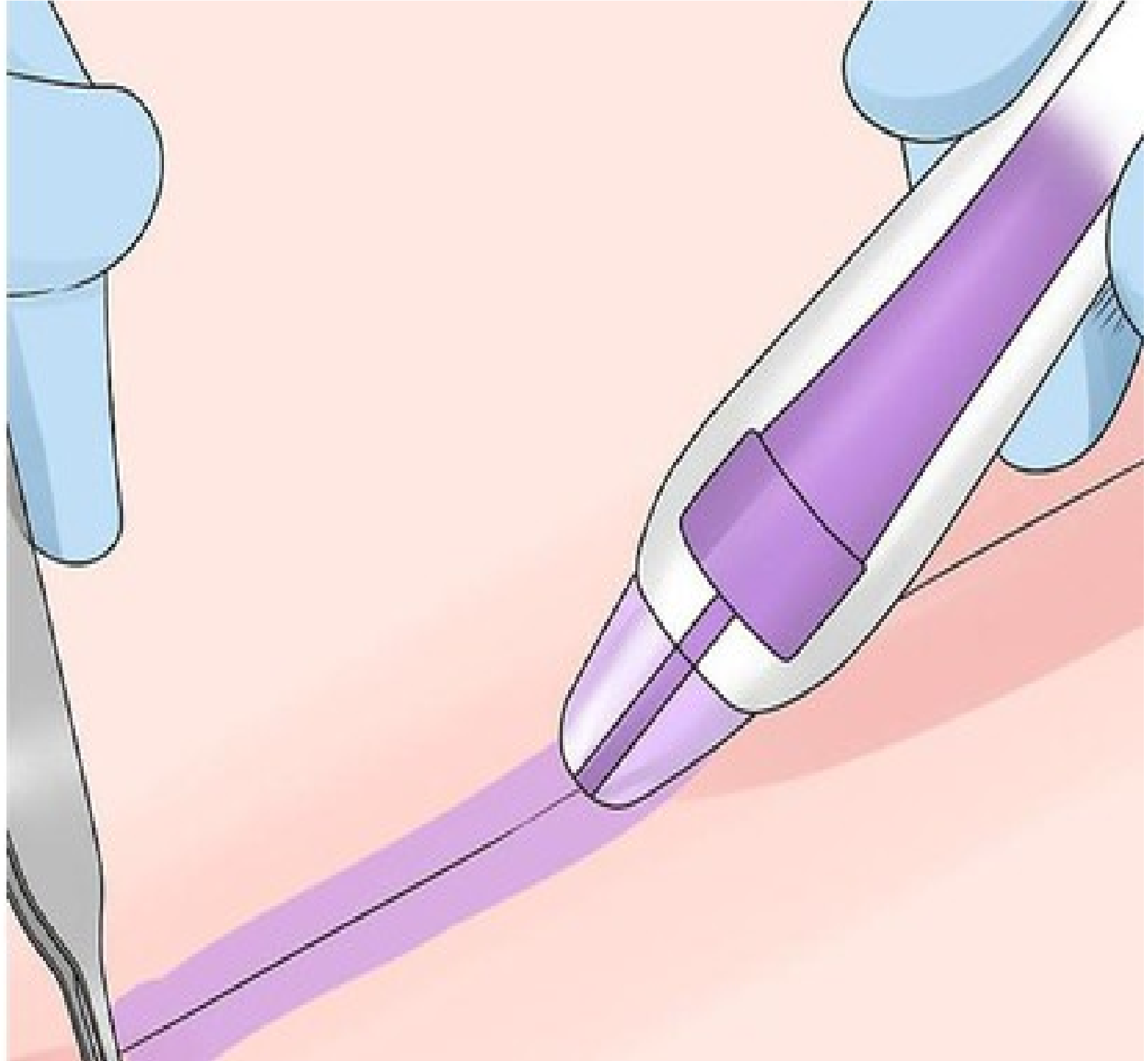 Thẩm mỹ ngực đẹp, an toàn cùng phương pháp nâng ngực nội soi không khâu da