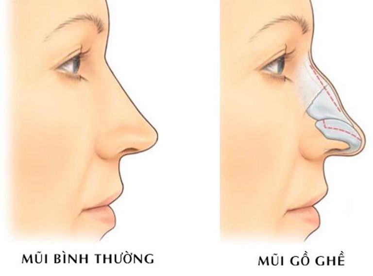 Mài xương gồ mũi – phương pháp tạo dáng mũi thon gọn