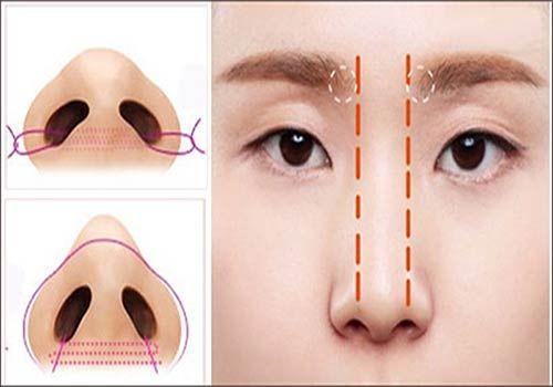 Thu nhỏ đầu mũi – Giúp dáng mũi thon gọn, thêm xinh