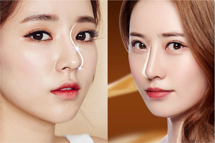 Sự khác biệt giữa nâng mũi L-Line và S-Line