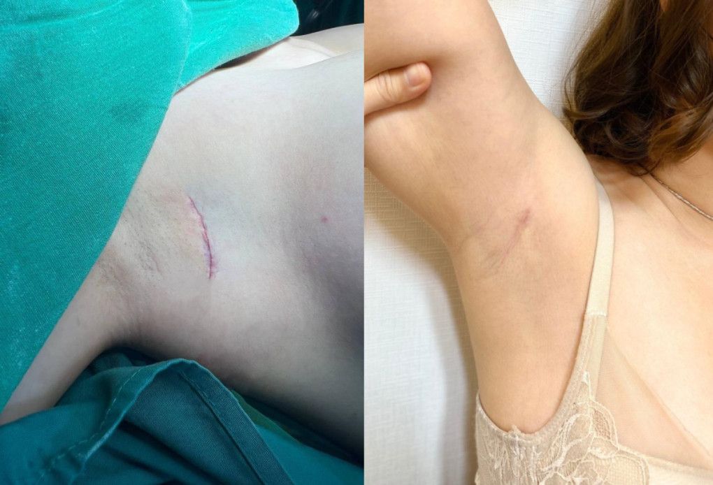 Phương pháp giảm sẹo trong phẫu thuật thẩm mỹ ngực bụng