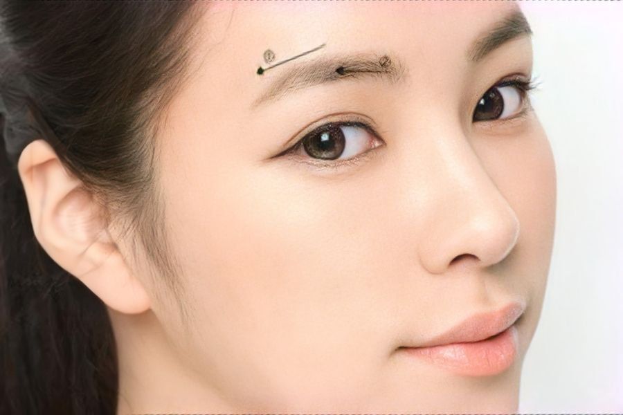 Nên cắt mí hay nâng cung chân mày để khắc phục tình trạng sụp mí