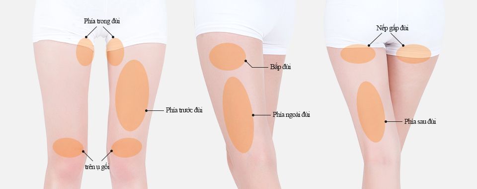 Hút mỡ đùi bằng công nghệ Vaser Lipo tại các bác sĩ của Trung Anh Group