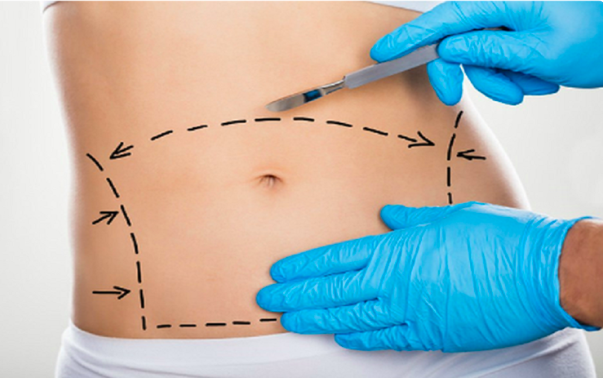 Những ai có thể thực hiện hút mỡ bụng?