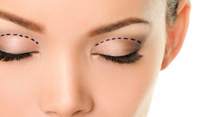 Phương pháp bấm mí mắt Multi-Point