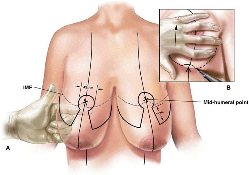 Giải pháp cho ngực chảy xệ sau sinh