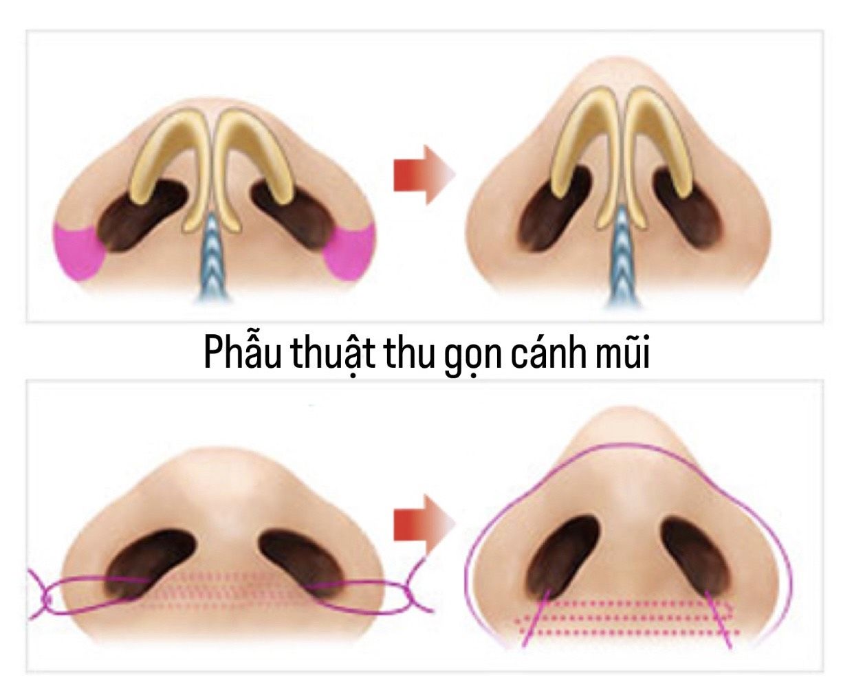 Phân biệt giữa phương pháp cuộn cánh mũi và cắt cánh mũi?