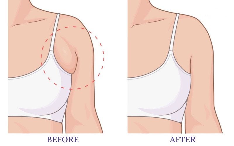 Những điều cần biết về phương pháp hút mỡ nách