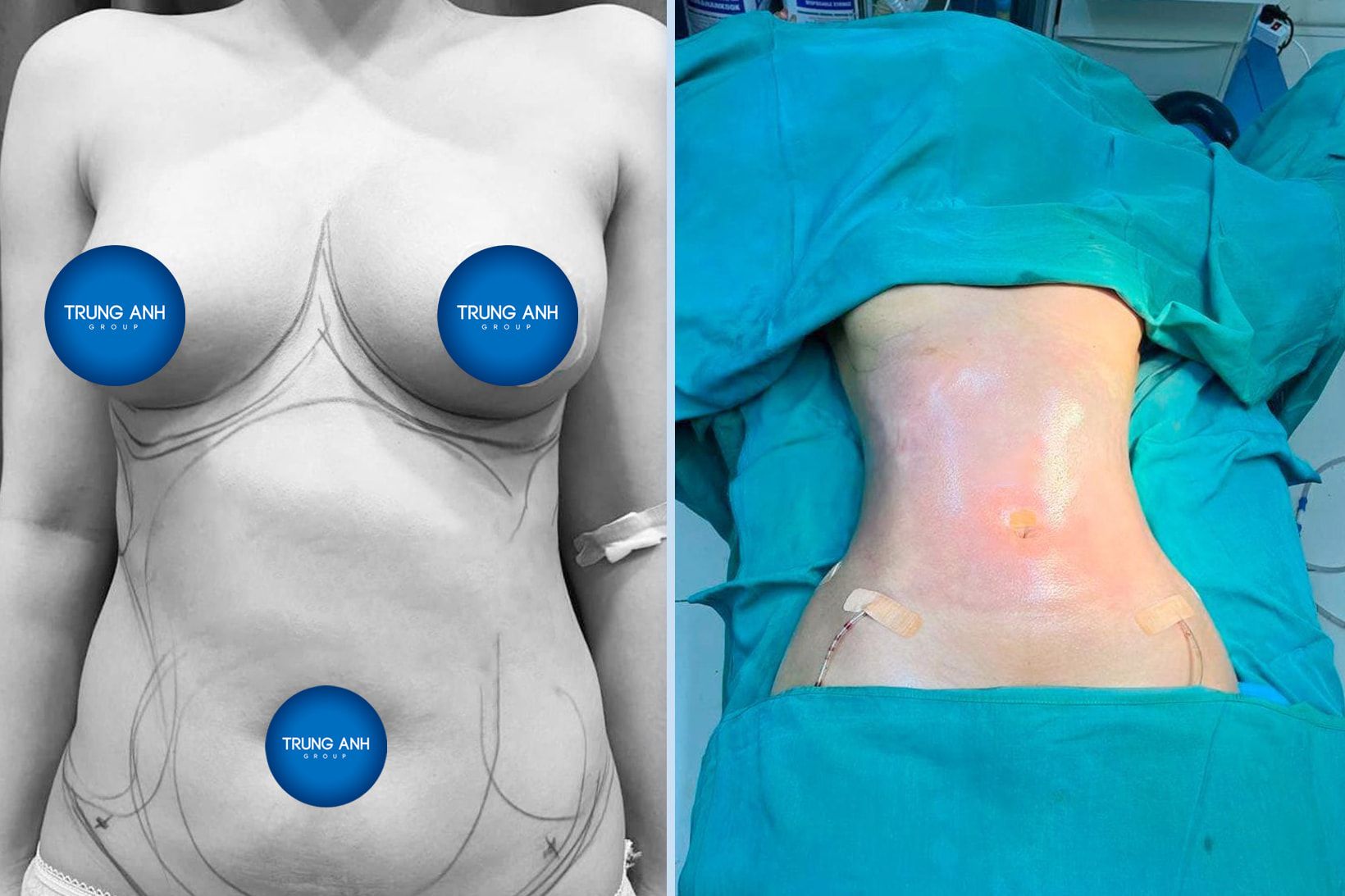 Phương pháp hút mỡ vaser lipo không phẫu liệu có tốt không?
