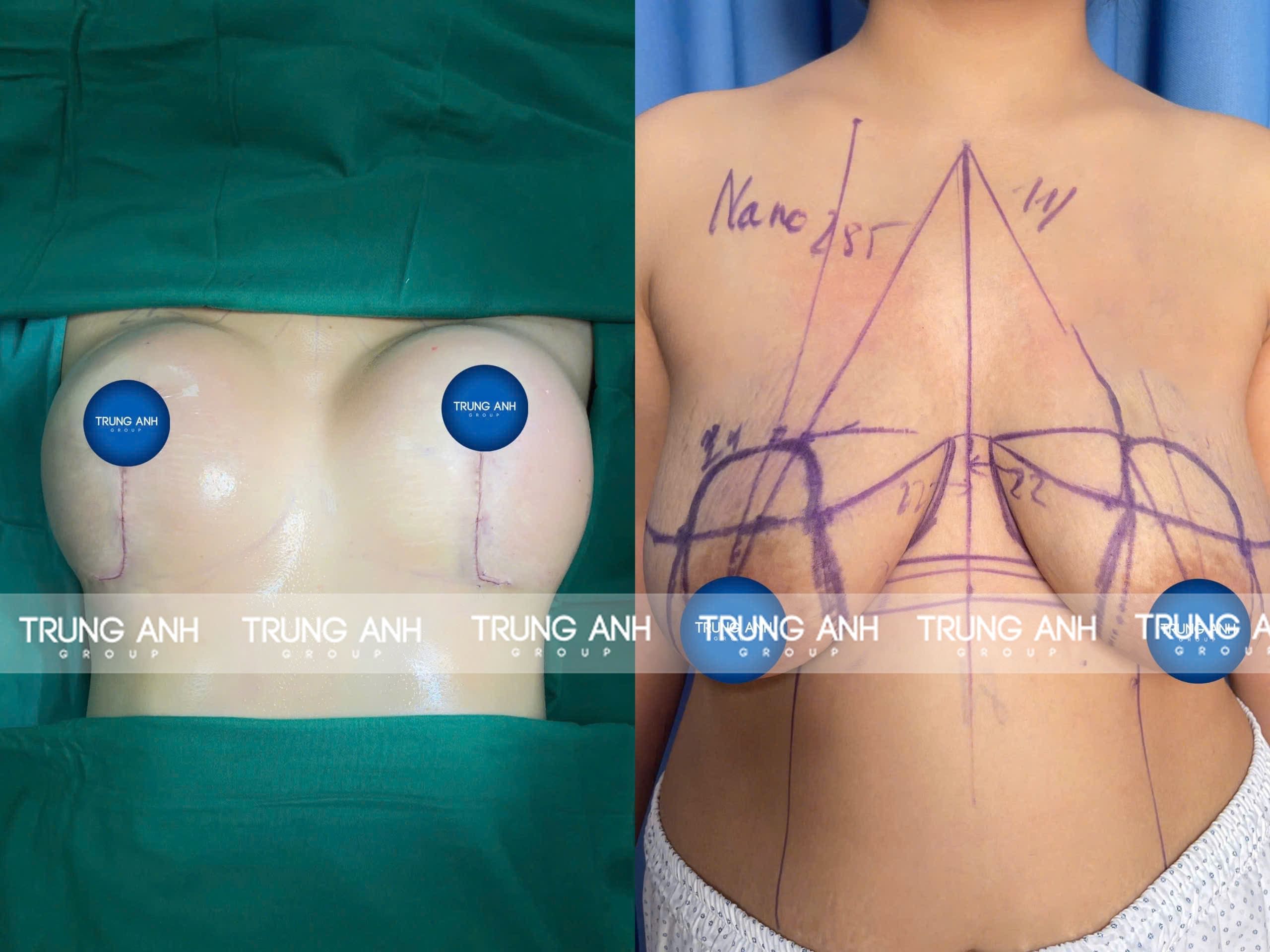 Tạo hình thẩm mỹ vòng 1 - Treo sa trễ chữ J Tạo hình thẩm mỹ vòng 1 - Treo sa trễ chữ J