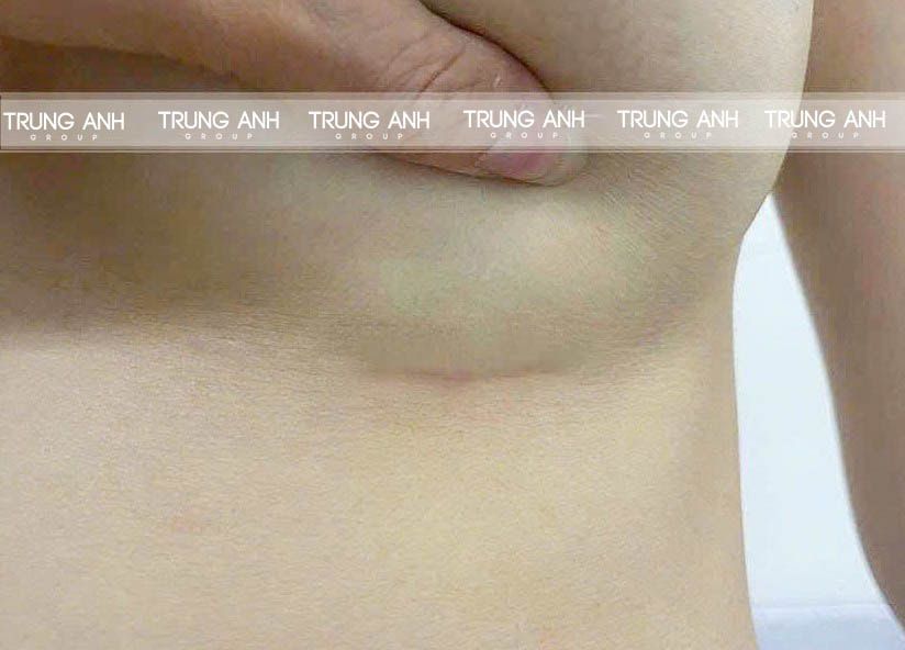 Nâng ngực đường chân ngực