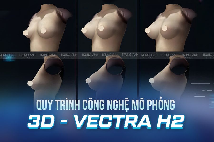 Công nghệ mô phỏng 3D Vectra H2 trong thẩm mỹ nâng ngực