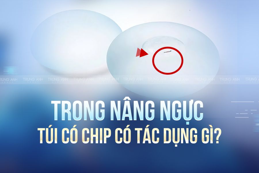 Trong thẩm mỹ nâng ngực túi ngực có chip có tác dụng gì?