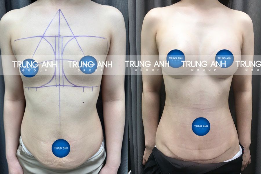 Tiêu chí để thực hiện thẩm mỹ combo hút mỡ