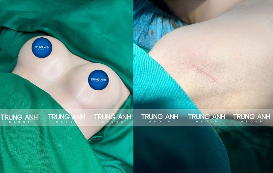 Ứng dụng khâu vi phẫu tạo đường sẹo mảnh trong thẩm mỹ ngực