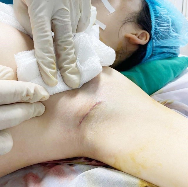 Bác sĩ thẩm mỹ chia sẻ về các đường mổ trong phẫu thuật nâng ngực - Ảnh 2. Bác sĩ thẩm mỹ chia sẻ về các đường mổ trong phẫu thuật nâng ngực - Ảnh 2.