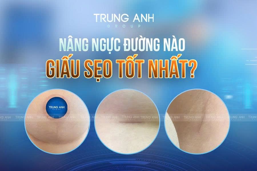 Nâng ngực đường nào giấu sẹo tốt nhất?