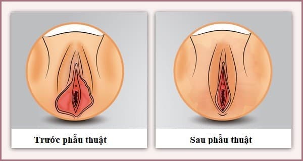 Hình ảnh trước và sau kh phẫu thuật tạo hình môi bé