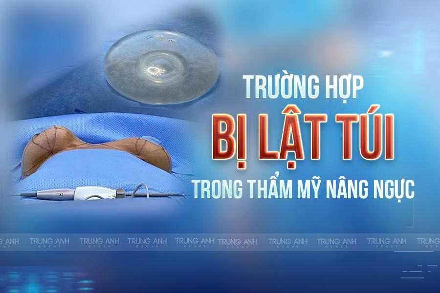 Trường hợp bị lật túi trong thẩm mỹ nâng ngực