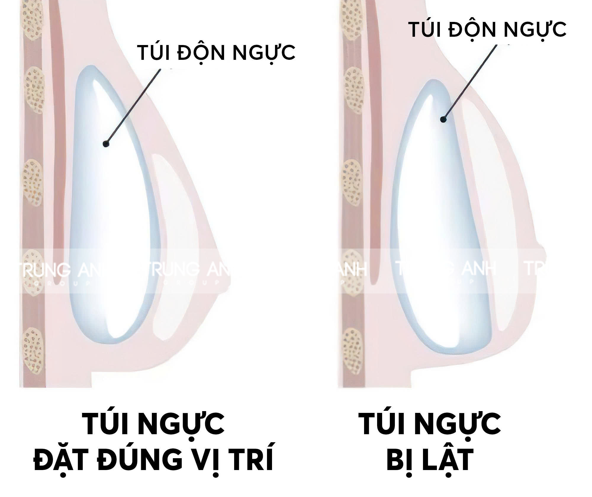 Trường hợp bị lật túi trong thẩm mỹ nâng ngực