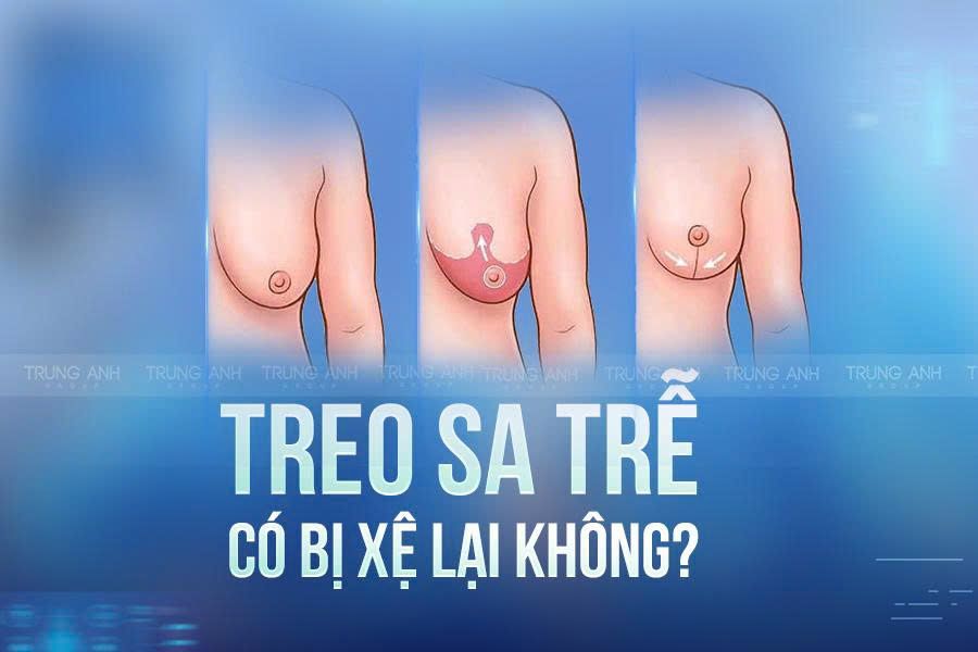 Treo sa trễ có bị xệ lại không?