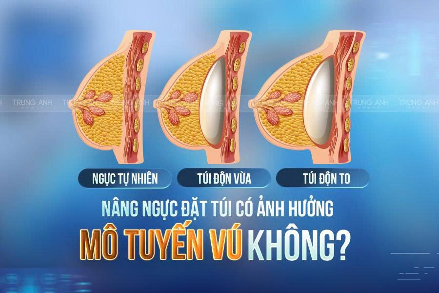 Nâng ngực đặt túi có ảnh hưởng đến mô tuyến vú không?