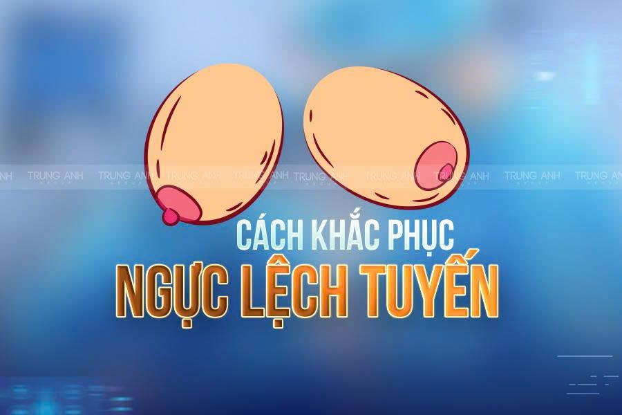 Cách khắc phục ngực lệch tuyến trong thẩm mỹ nâng ngưc